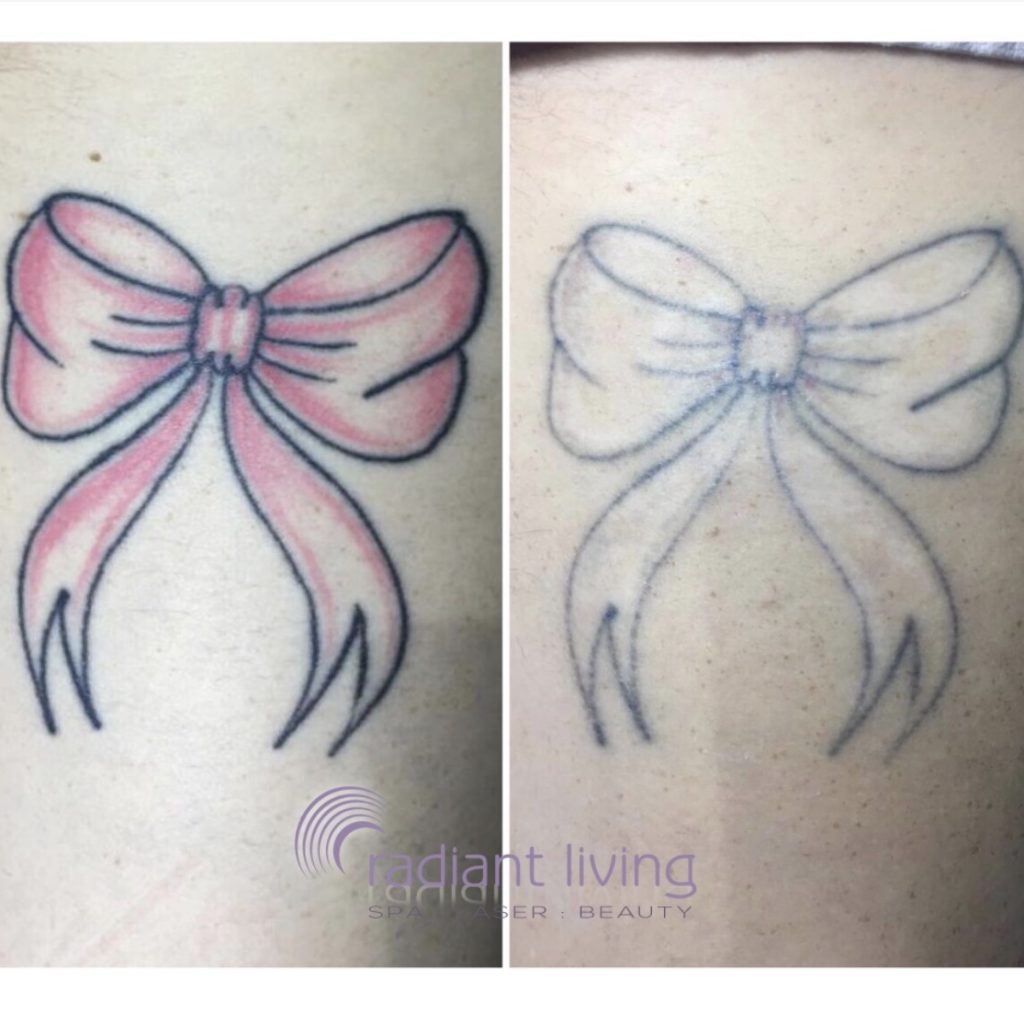 Bow Tattoo Before After