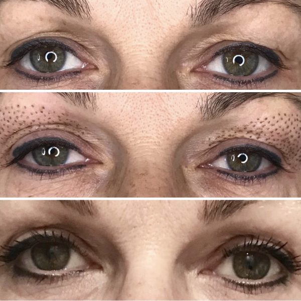 tighten eyelids without surgery