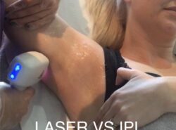 Which is better IPL or Laser Hair Removal?