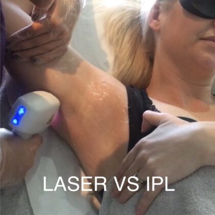 Which is better IPL or Laser Hair Removal?