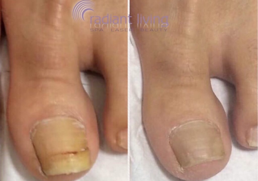 Fungal Nail Treatment - with medical lasers at Radiant Living