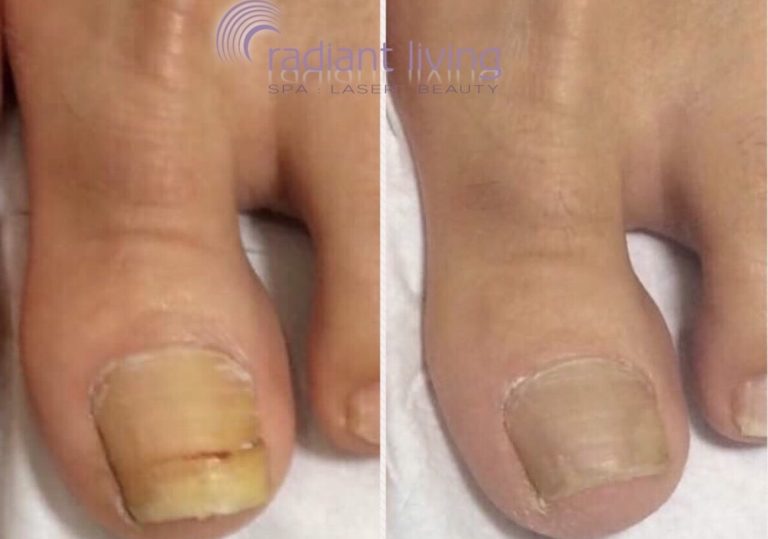 Fungal Nail Treatment with medical lasers at Radiant Living