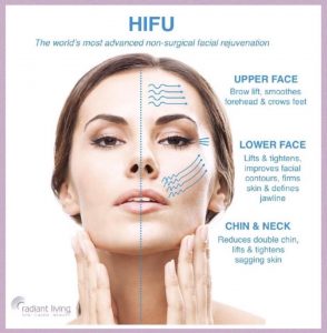 HIFU non surgical facelift
