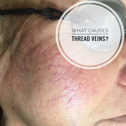 What causes thread veins on your face?