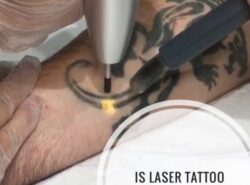 Does Laser tattoo removal hurt?