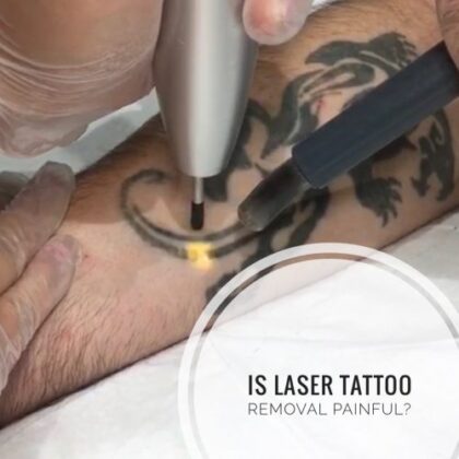 Does Laser tattoo removal hurt?