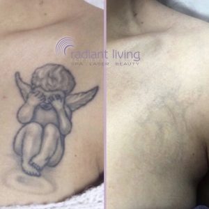 Tattoo Removal Before & After Photos, Tattoo Removal Patient Results