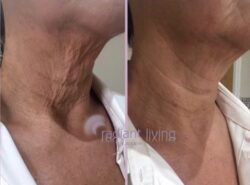 Can you tighten a saggy neck without surgery?