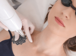 Picosure Laser vs Q Switch tattoo removal. Which is best?