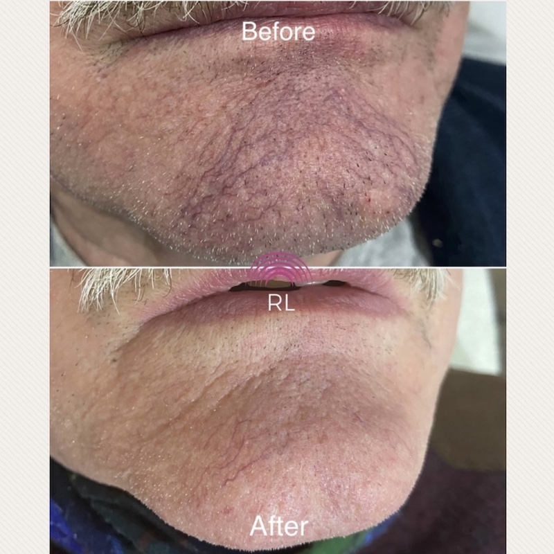 Red veins chin before and after