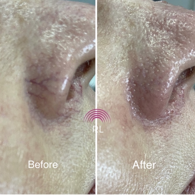 How do you remove spider veins on your nose?