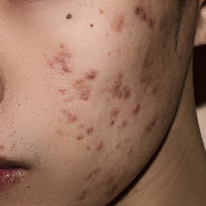 What’s the best way to remove acne scars fast?