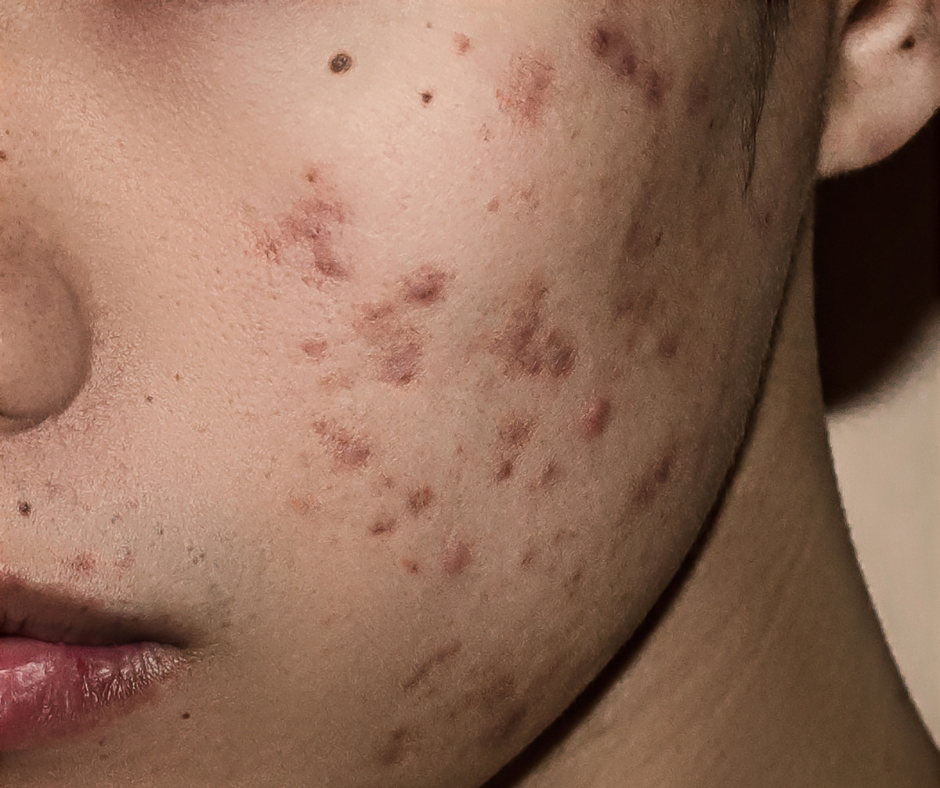 remove acne scars fast