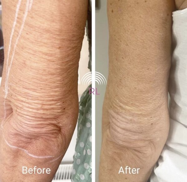 Arm tightening before after Radiant Living