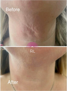 Thread Lift on Neck at Radiant Living, Wigan