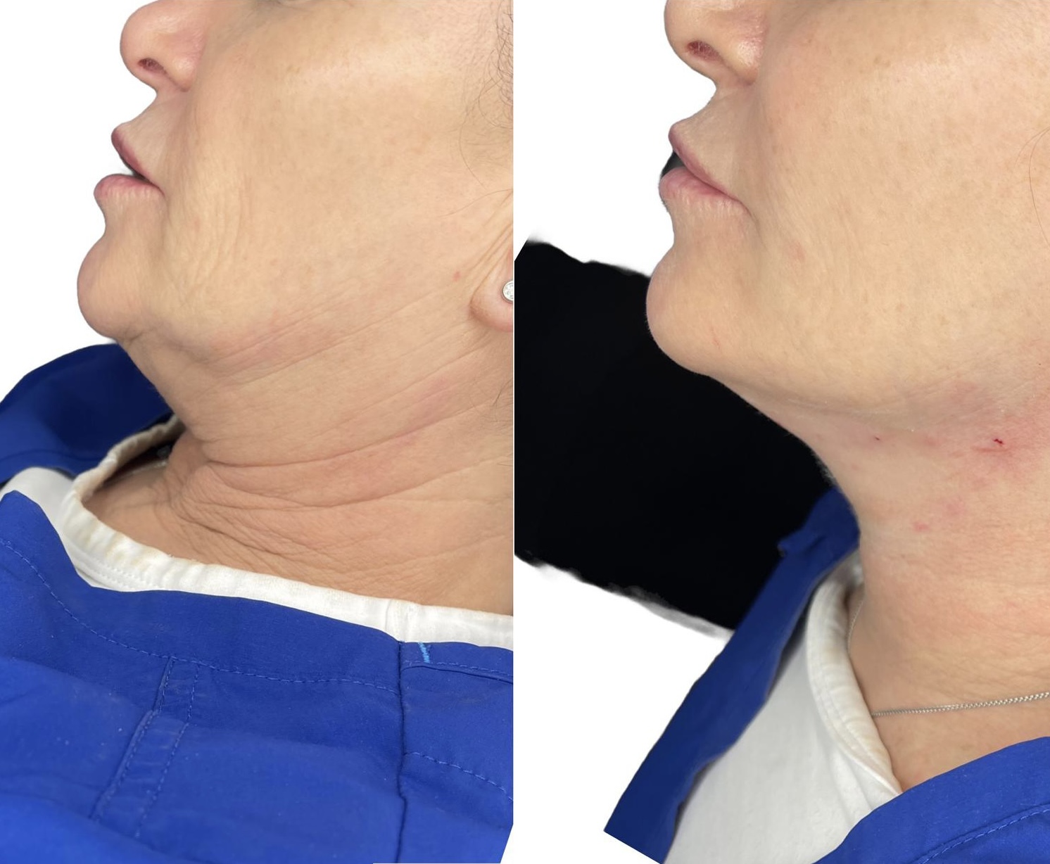 Thread Lift Face and Neck