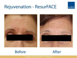 Fractional Laser Resurfacing Deep Lines Before and After
