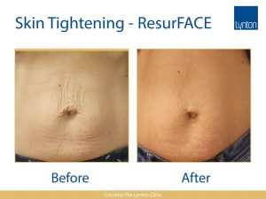 Fractional Laser Resurfacing Stretch Marks