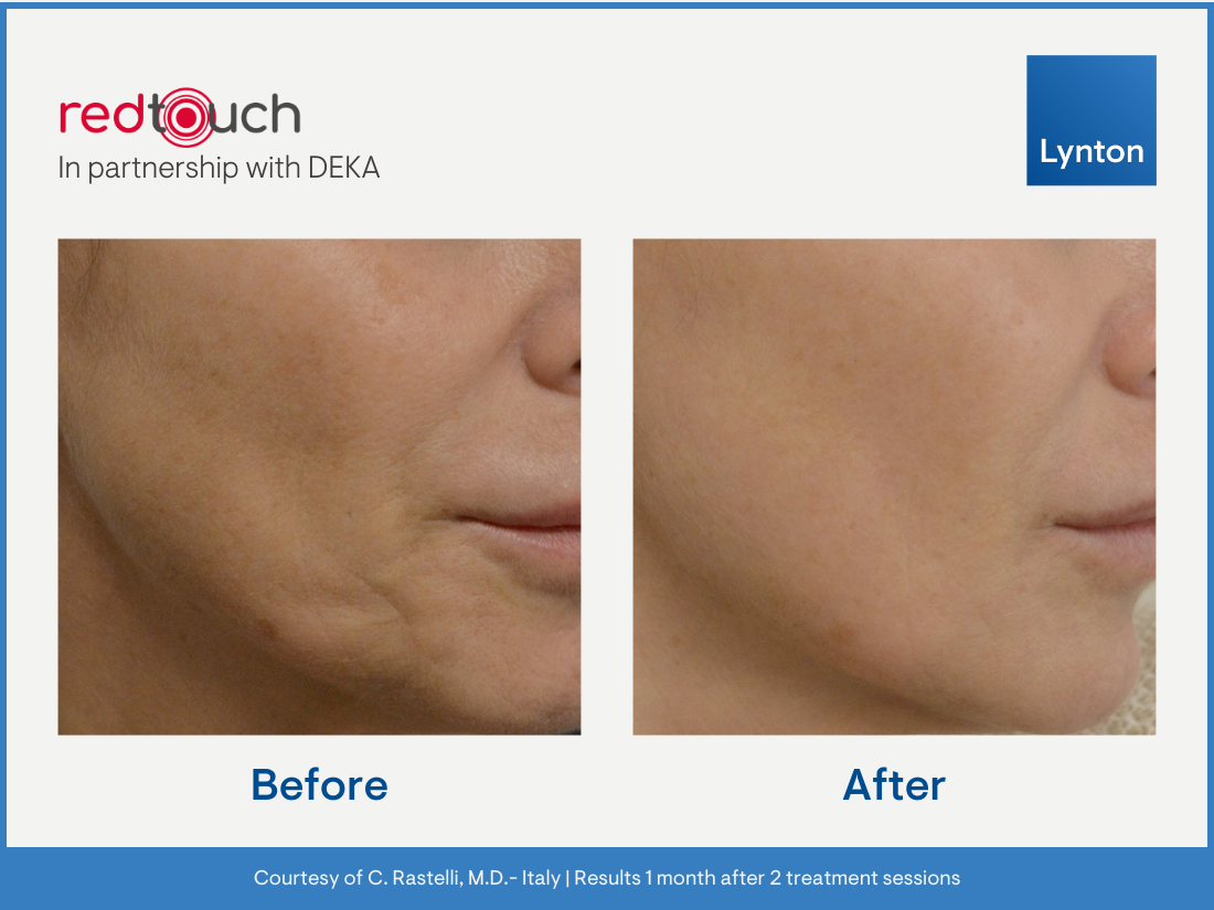 Red Touch Pro Before After Men's Hair at Radiant Living