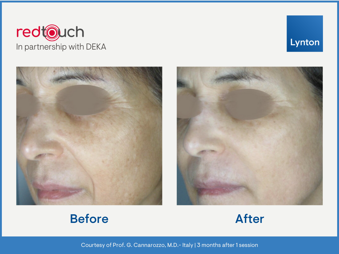 Red Touch Pro Results