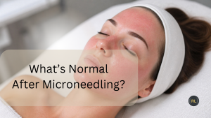 Mild redness on face after microneedling treatment showing normal skin response