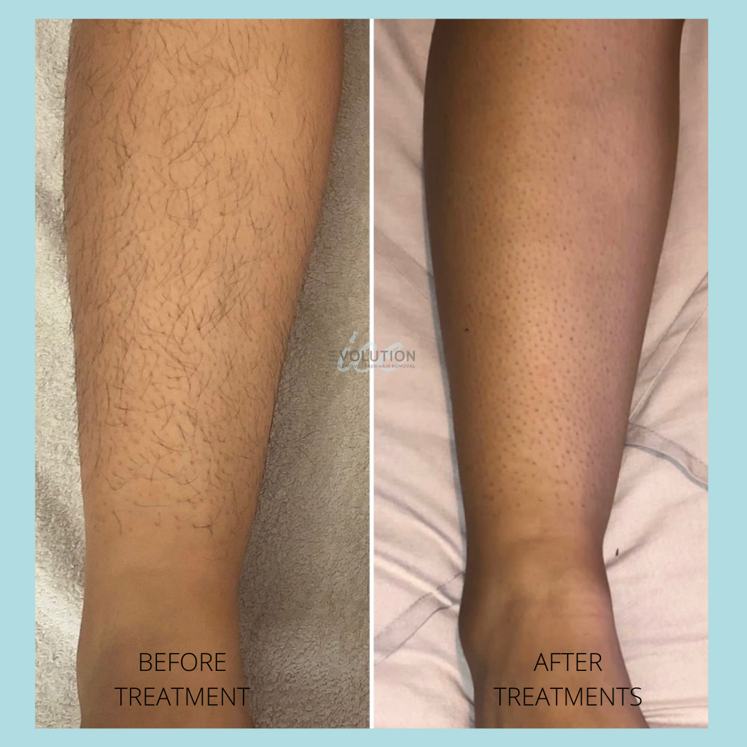 Fractional Laser Resurfacing Stretch Marks